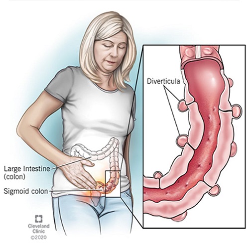 Diverticulitis